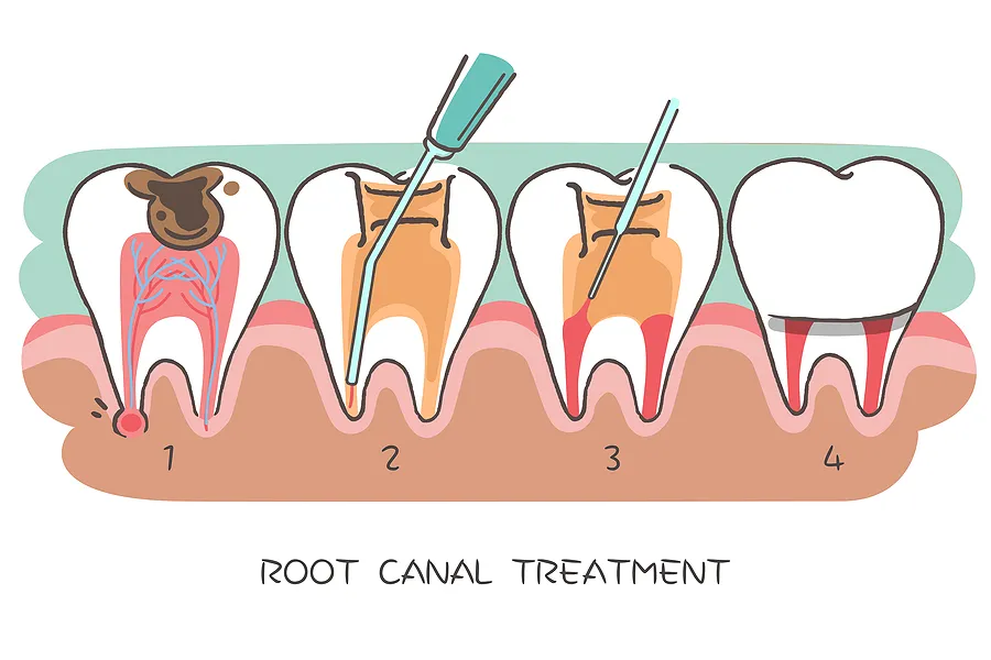 Saving Your Smile: Everything You Need to Know About Root Canals in New York NY