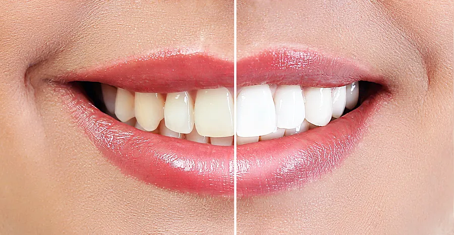 Brighten Your Smile: Expert Teeth Whitening in New York NY for Lasting Results