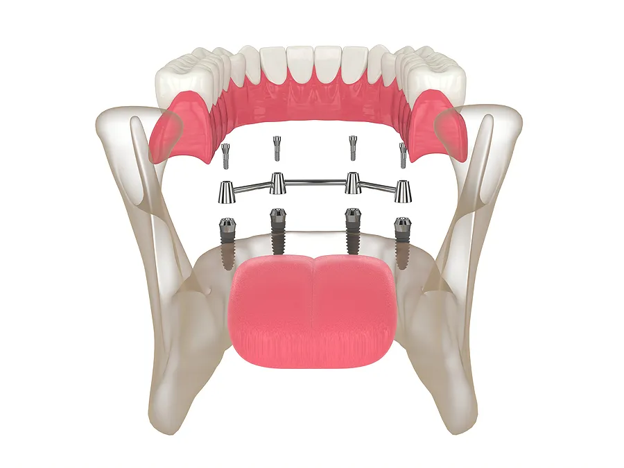 Transform Your Smile with All-on-4 Implants in New York NY: The Ultimate Solution for Missing Teeth