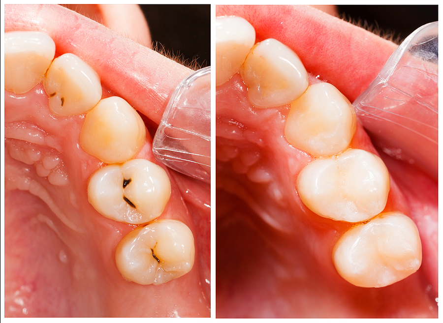 A Comprehensive Guide to Dental Fillings in New York, NY: Restoring Your Oral Health