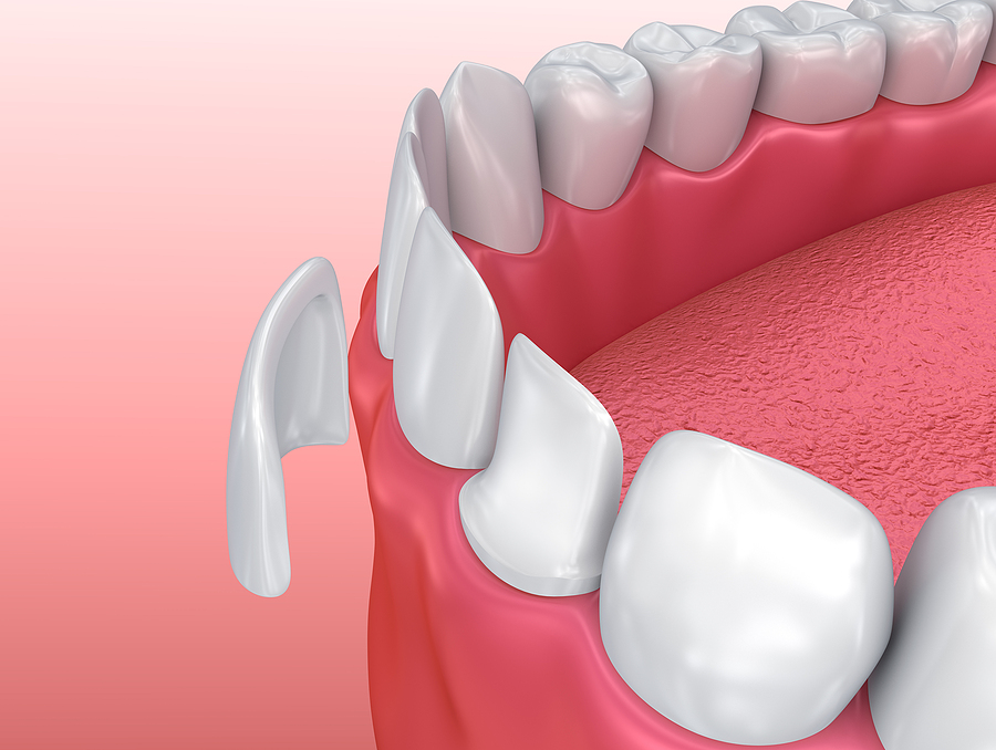 Transform Your Smile with Dental Veneers in New York, NY