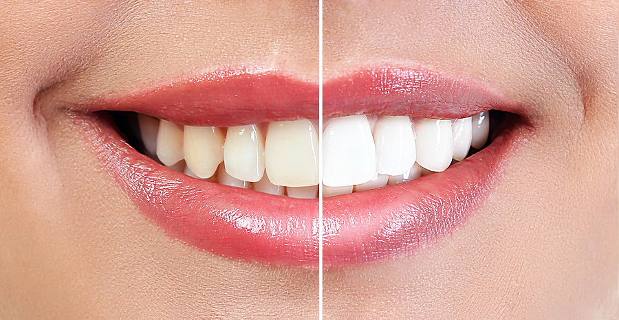 Brighten Your Smile: Expert Teeth Whitening in New York, NY for Lasting Results